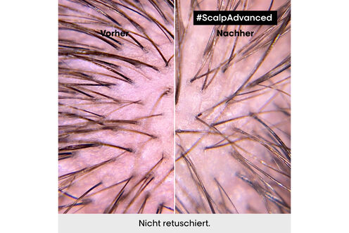 Scalp Advanced Anti-Discomfort Dermo-Regulator Shampoo - Scalp Advanced | L'Oréal Partner Shop